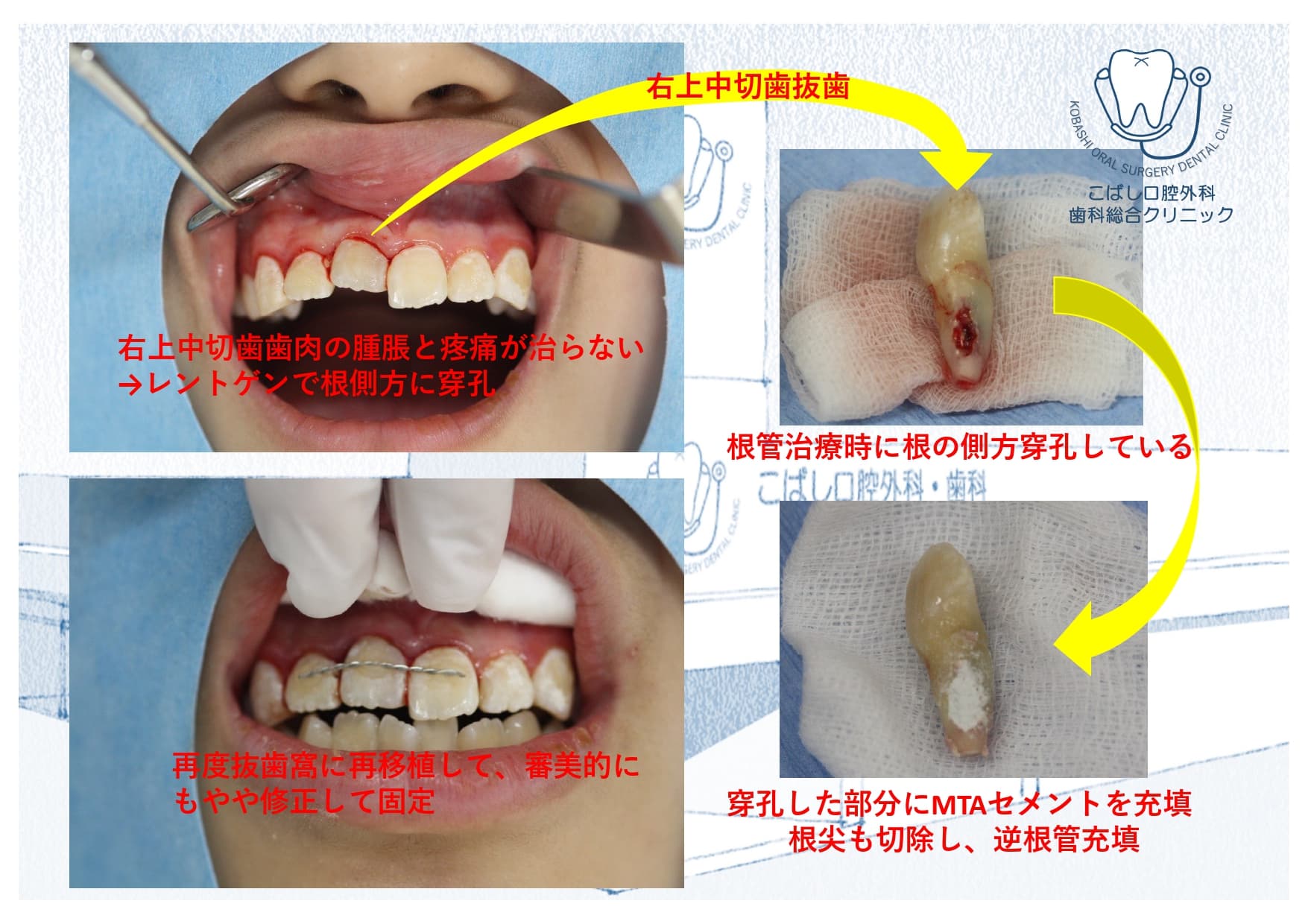 【症例】抜歯・再移植処置