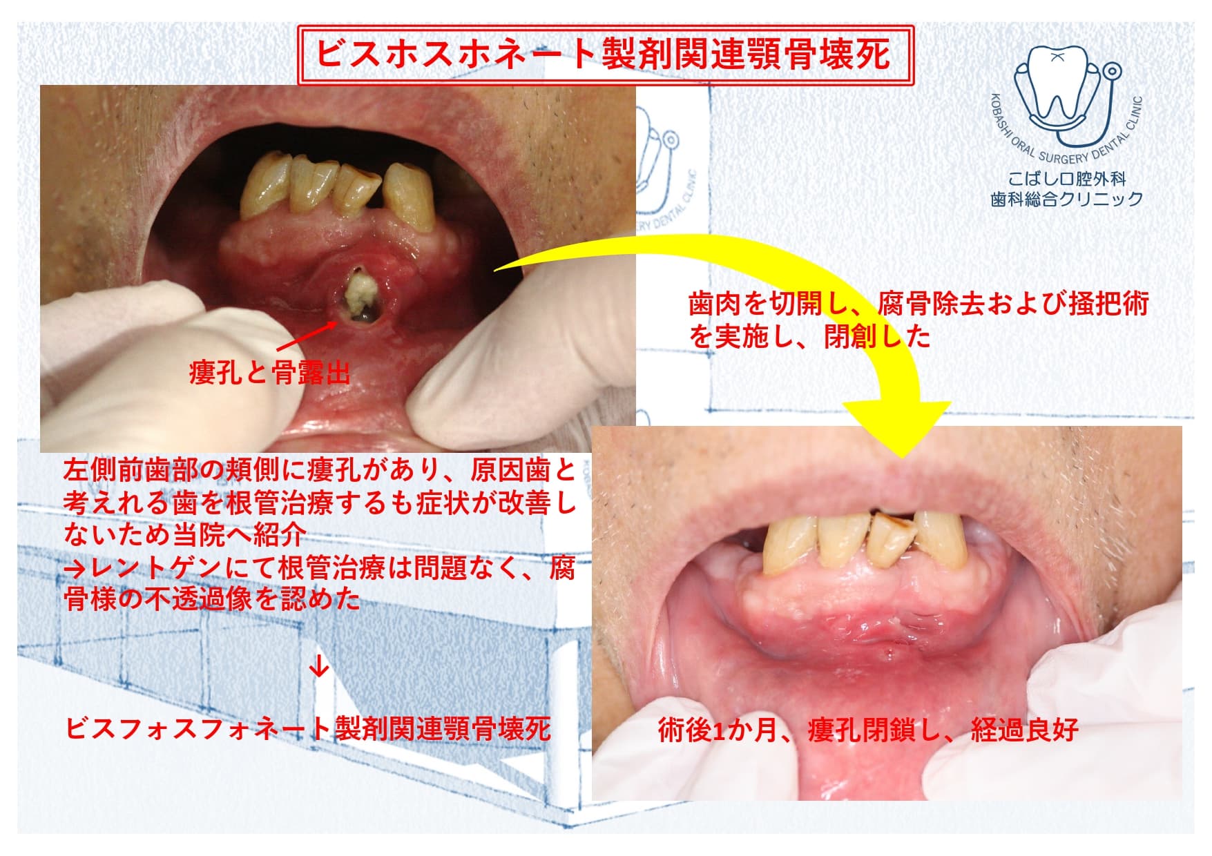 【症例】ビスホスホネート製剤関連顎骨壊死